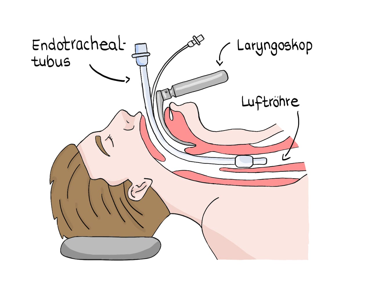 Abbildung Intubation