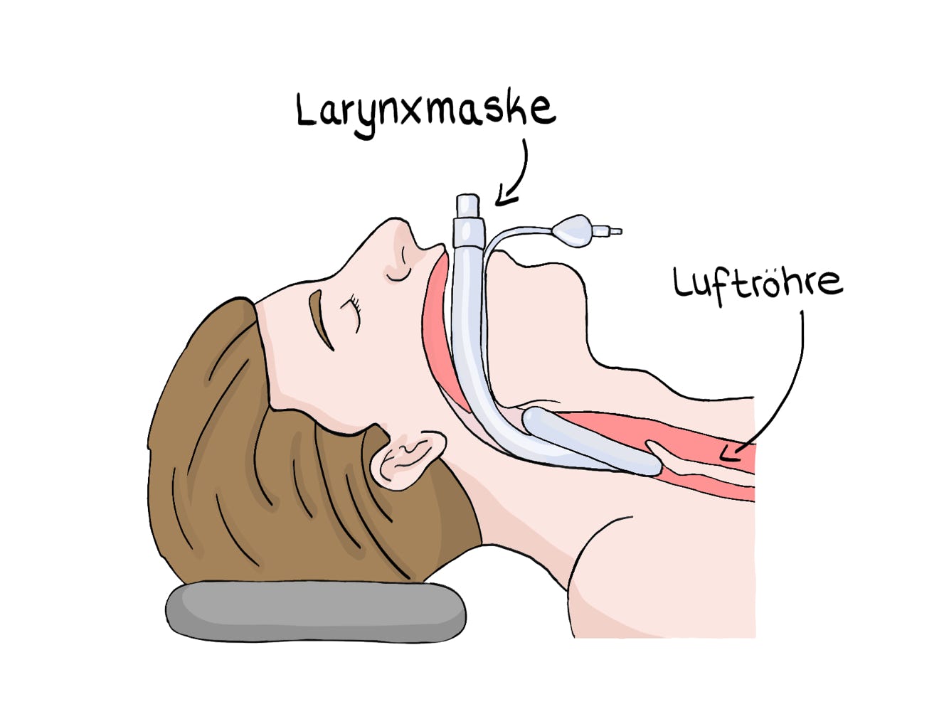 Abbildung Larynxmaske